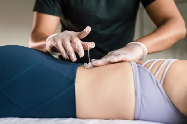 ims dry needling