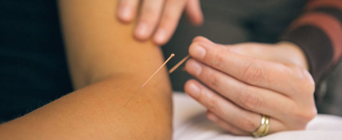 Acupuncture Therapy | North Vancouver Physiotherapy and Sport Injury Clinic