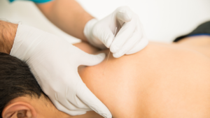 what is dry needling