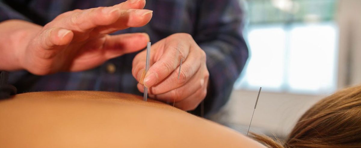 Traditional Chinese Acupuncture | North VancouverPhysiotherapy and Sport Injury Clinic